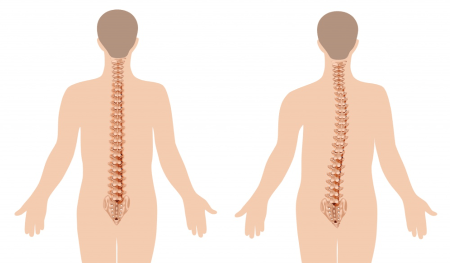 projev osteochondrózy